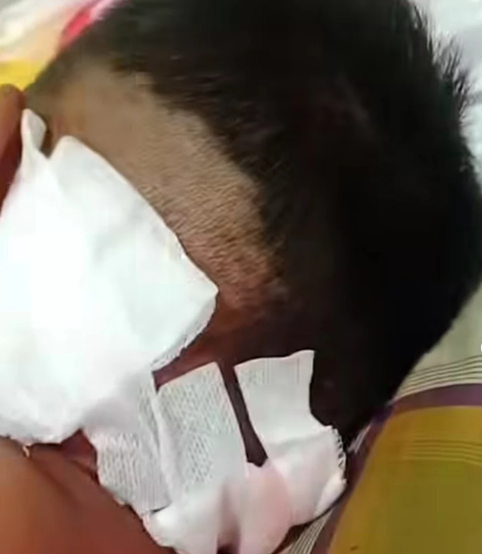 ANAK SD DI KONAWE UTARA DIDUGA DIANIAYA PAKAI GUNTING, TUBUH DIPENUHI 48 LUKA